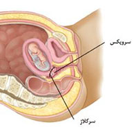 سرکلاژ-در-بارداری