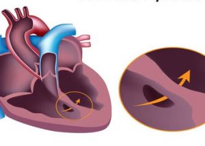 سوراخ-قلب-نوزاد