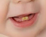 سیاه شدن دندان نوزاد