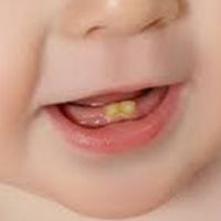 سیاه شدن دندان نوزاد