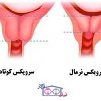 کم-شدن-طول-سرویکس-در-بارداری