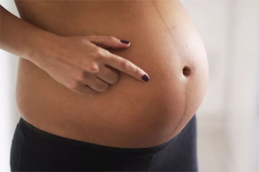 خط روی شکم در بارداری